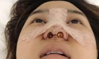 做鼻子整形要多少钱 鼻子整形需要多少钱